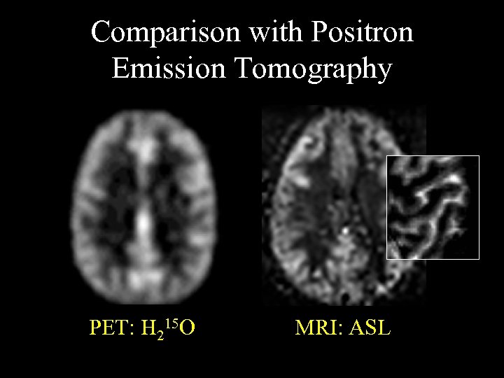 Comparison with Positron Emission Tomography PET: H 215 O MRI: ASL 