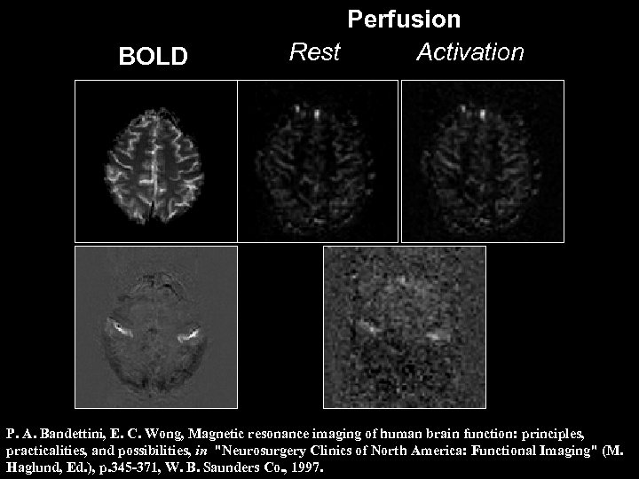 BOLD Perfusion Rest Activation P. A. Bandettini, E. C. Wong, Magnetic resonance imaging of