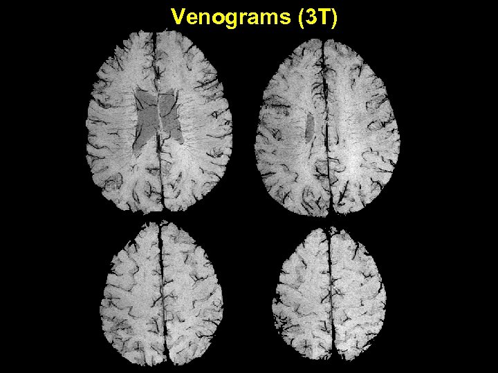 Venograms (3 T) 