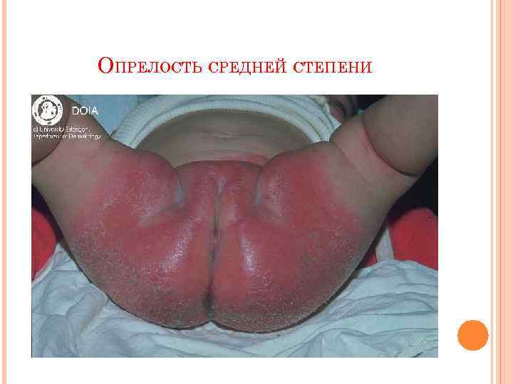 ОПРЕЛОСТЬ СРЕДНЕЙ СТЕПЕНИ 