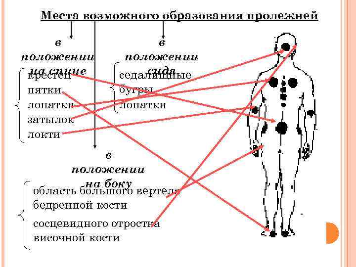 Места возможного образования пролежней в положении на спине крестец пятки лопатки затылок локти в