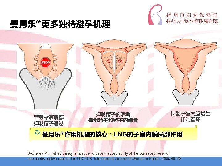 曼月乐®更多独特避孕机理 宫颈粘液增厚 抑制精子通过 抑制精子的活动 抑制精子和卵子的结合 抑制子宫内膜增生 抑制着床 曼月乐®作用机理的核心：LNG的子宫内膜局部作用 Bednarek PH，et al. Safety, efficacy and
