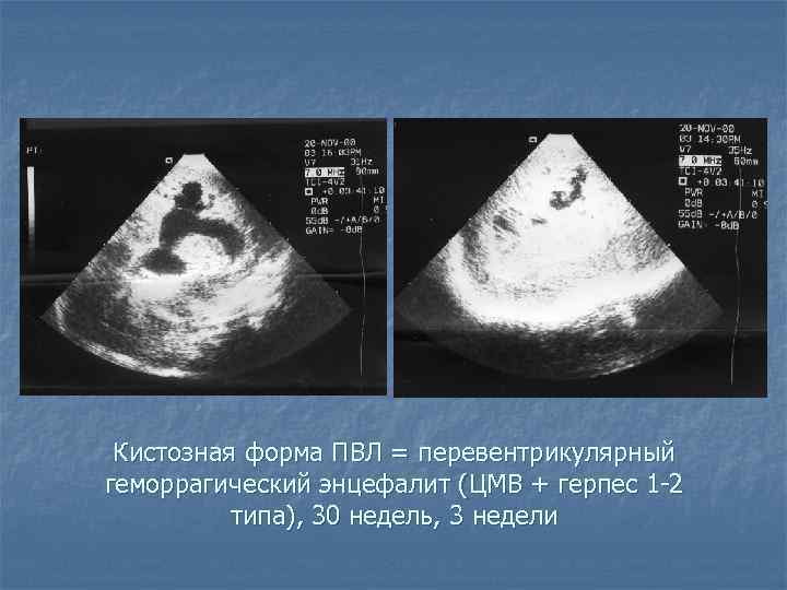 Лейкомаляция головного мозга у новорожденных