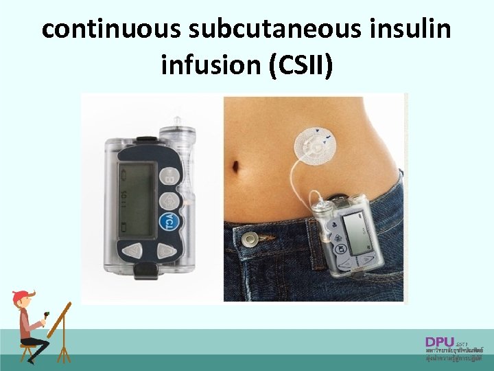 continuous subcutaneous insulin infusion (CSII) 