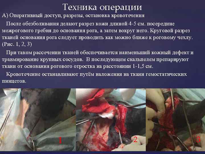 Техника операции А) Оперативный доступ, разрезы, остановка кровотечения После обезболивания делают разрез кожи длиной