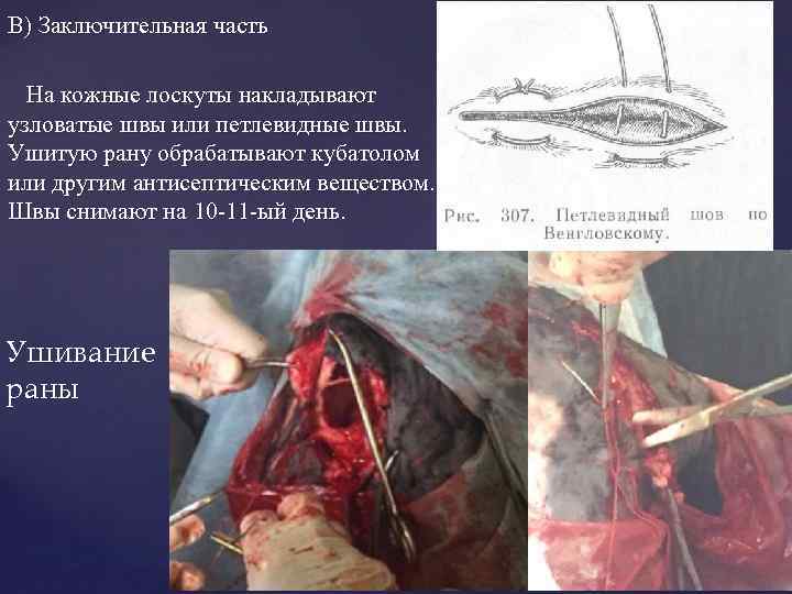 В) Заключительная часть На кожные лоскуты накладывают узловатые швы или петлевидные швы. Ушитую рану