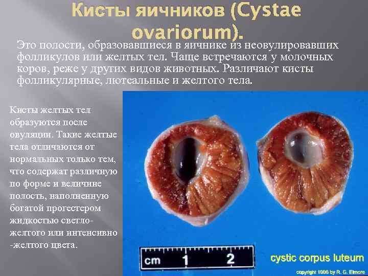 Кисты яичников (Cystae ovariorum). Это полости, образовавшиеся в яичнике из неовулировавших фолликулов или желтых