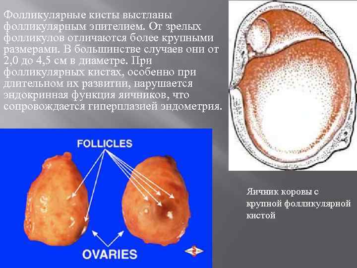 Фолликулярные кисты выстланы фолликулярным эпителием. От зрелых фолликулов отличаются более крупными размерами. В большинстве