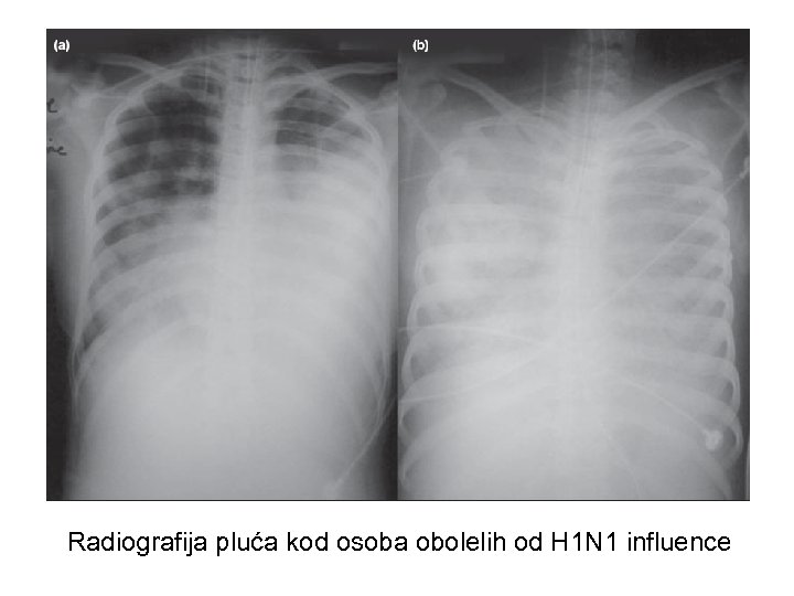  Radiografija pluća kod osoba obolelih od H 1 N 1 influence 