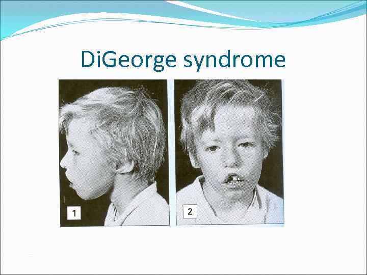 Di. George syndrome 