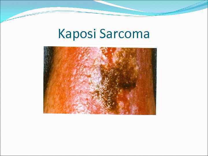 Kaposi Sarcoma 