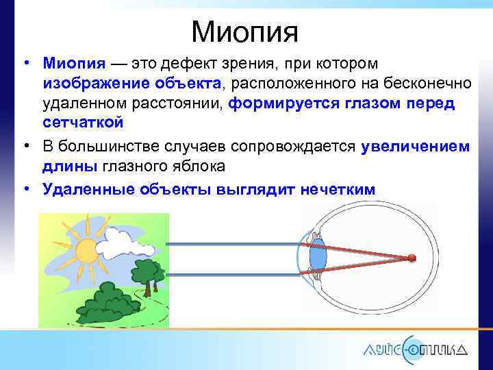 Изображение предмета находится перед сетчаткой