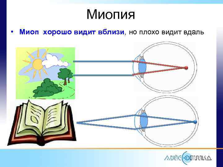 Миопия • Миоп хорошо видит вблизи, но плохо видит вдаль 