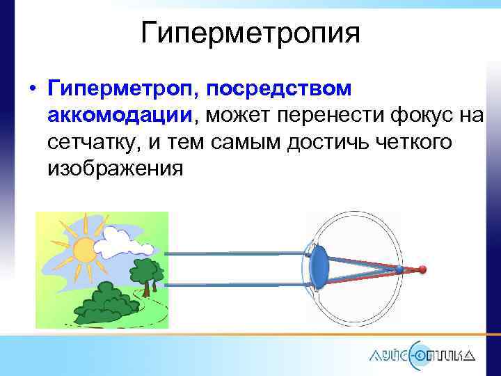 Гиперметропия • Гиперметроп, посредством аккомодации, может перенести фокус на сетчатку, и тем самым достичь