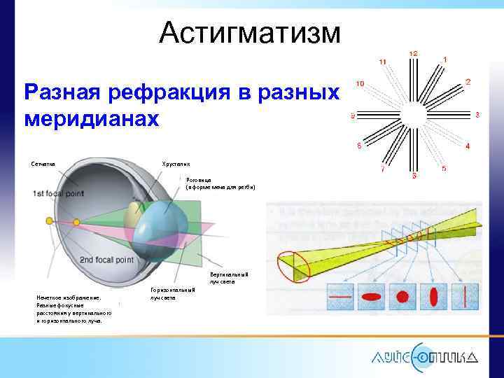 Астигматизм Разная рефракция в разных меридианах Сетчатка Хрусталик Роговица (в форме меча для регби)