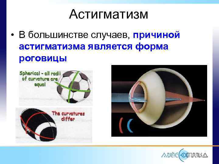 Астигматизм • В большинстве случаев, причиной астигматизма является форма роговицы 