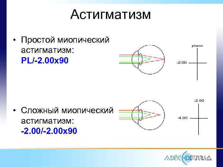 Астигматизм • Простой миопический астигматизм: PL/-2. 00 x 90 • Сложный миопический астигматизм: -2.
