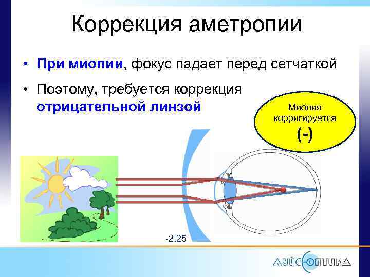 Фокус изображения при миопии