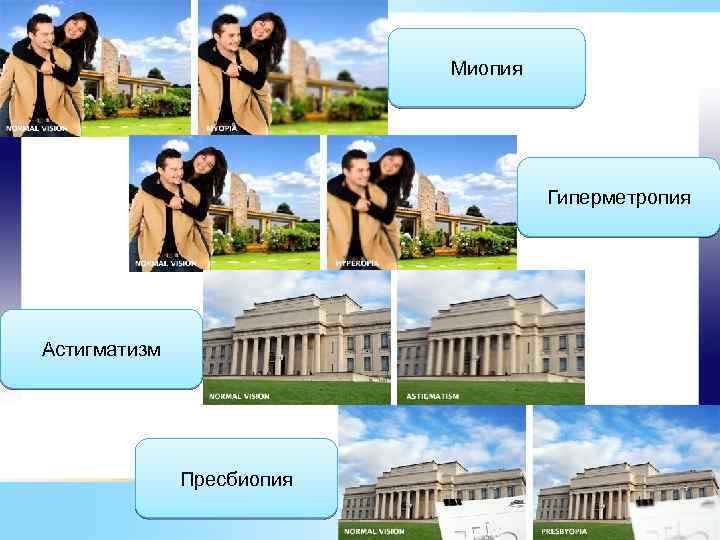Миопия Гиперметропия Астигматизм Пресбиопия 