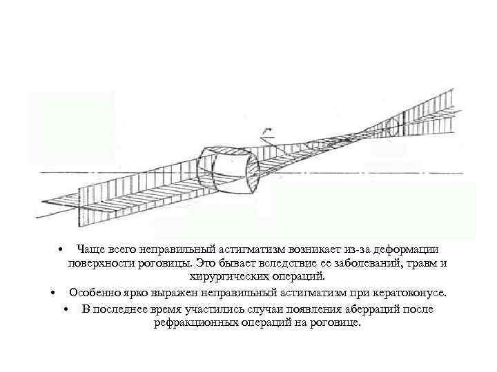  • Чаще всего неправильный астигматизм возникает из-за деформации поверхности роговицы. Это бывает вследствие