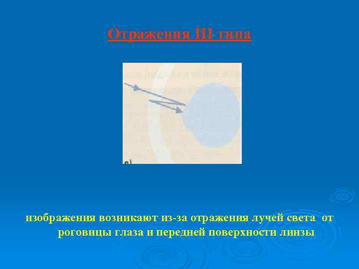 Отражения III типа изображения возникают из-за отражения лучей света от роговицы глаза и передней