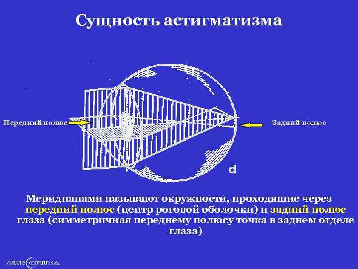 Сущность астигматизма . Передний полюс Задний полюс Меридианами называют окружности, проходящие через передний полюс