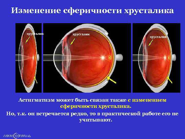 Изменение сферичности хрусталика хрусталик Астигматизм может быть связан также с изменением сферичности хрусталика. Но,