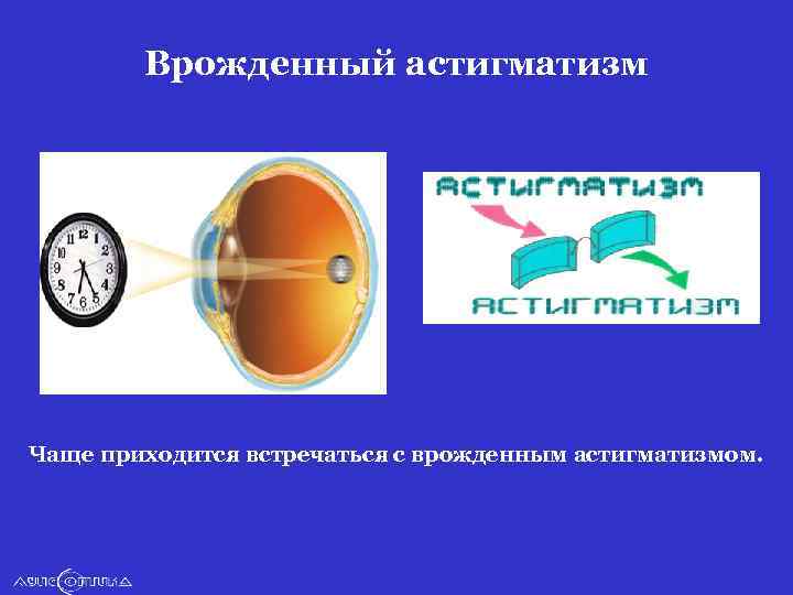 Врожденный астигматизм Чаще приходится встречаться с врожденным астигматизмом. 