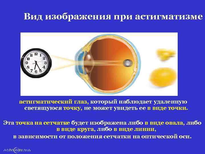 Вид изображения при астигматизме астигматический глаз, который наблюдает удаленную светящуюся точку, не может увидеть