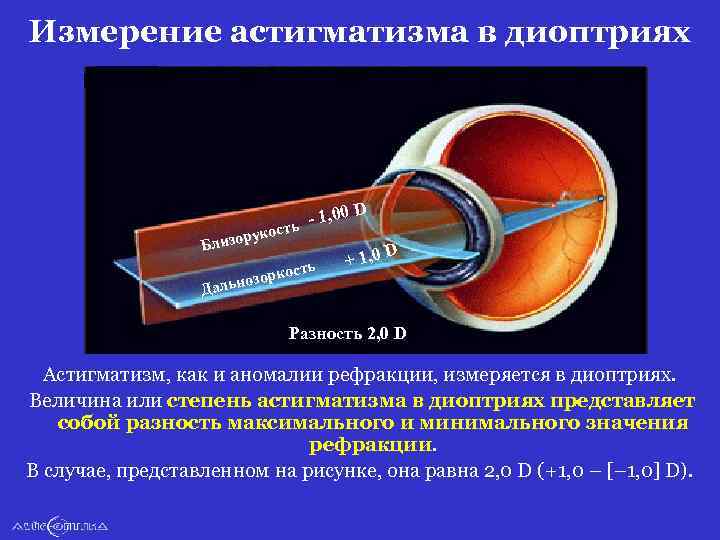 Измерение астигматизма в диоптриях - 1, 00 D кость изору Бл D + 1,