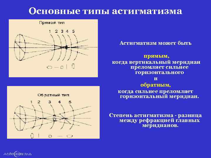 Основные типы астигматизма Астигматизм может быть прямым, когда вертикальный меридиан преломляет сильнее горизонтального и