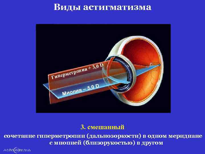 Виды астигматизма D тр ерме Гип 3, 0 ия + оп , 0 D