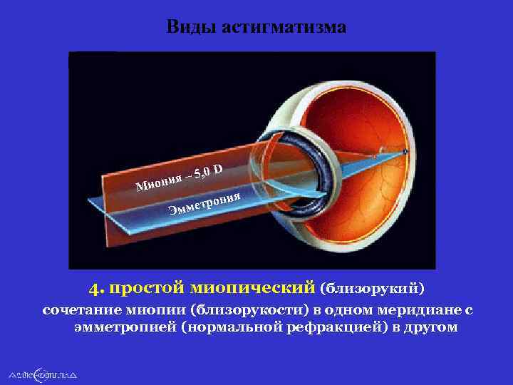 Виды астигматизма D , 0 ия – 5 оп Ми ия роп ммет Э