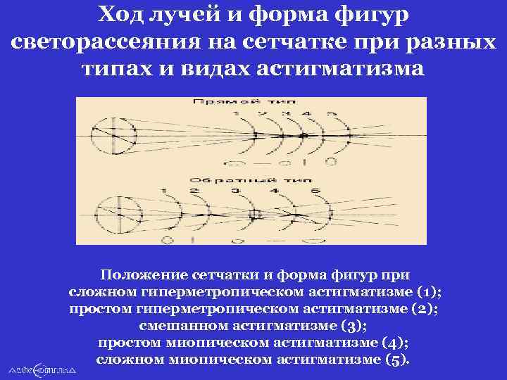 Ход лучей и форма фигур светорассеяния на сетчатке при разных типах и видах астигматизма