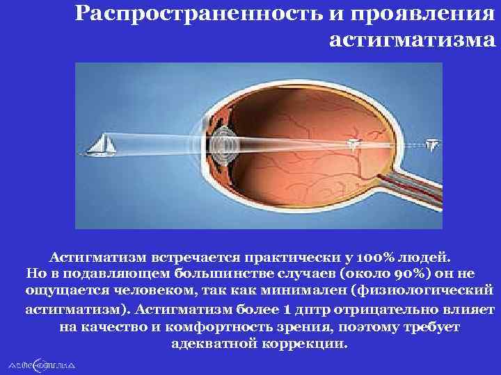 Как фокусируется изображение рассматриваемого предмета при астигматизме