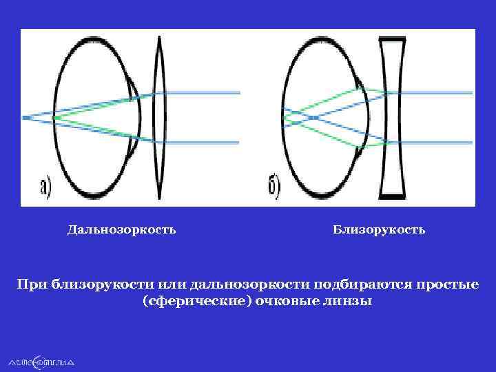 Дальнозоркость Близорукость При близорукости или дальнозоркости подбираются простые (сферические) очковые линзы 