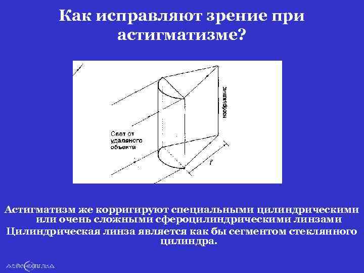 Как исправляют зрение при астигматизме? Астигматизм же корригируют специальными цилиндрическими или очень сложными сфероцилиндрическими