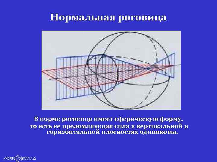 Нормальная роговица В норме роговица имеет сферическую форму, то есть ее преломляющая сила в