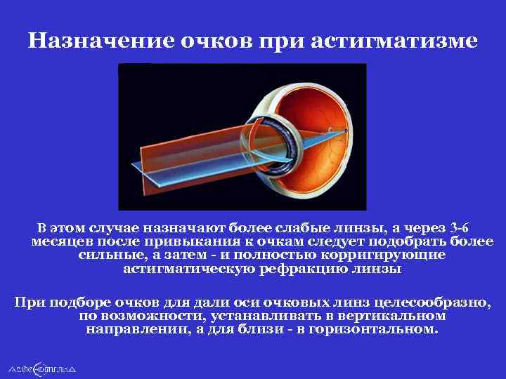 Назначение очков при астигматизме В этом случае назначают более слабые линзы, а через 3