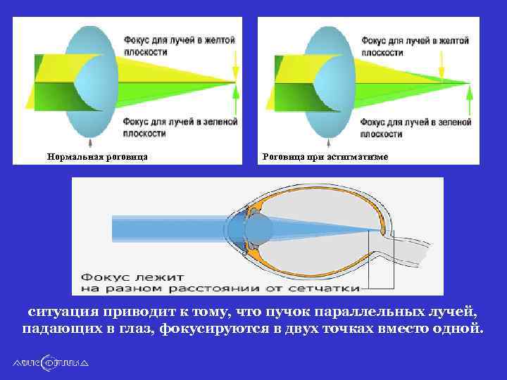 Как фокусируется изображение рассматриваемого предмета при астигматизме