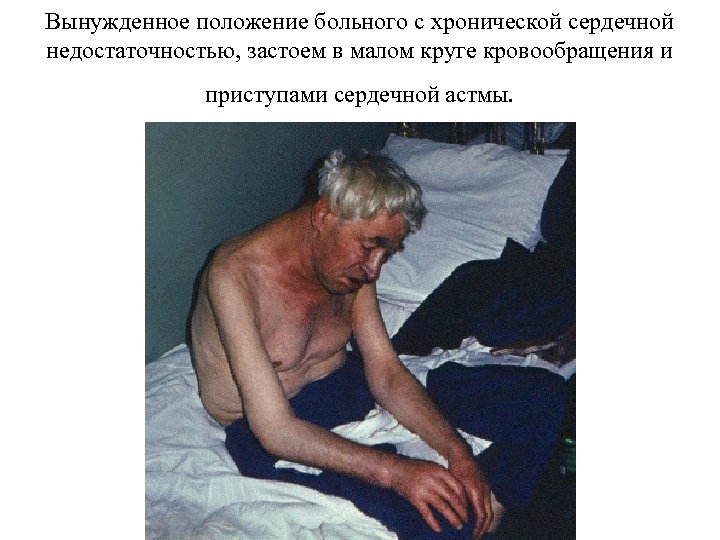 Вынужденное положение больного с хронической сердечной недостаточностью, застоем в малом круге кровообращения и приступами