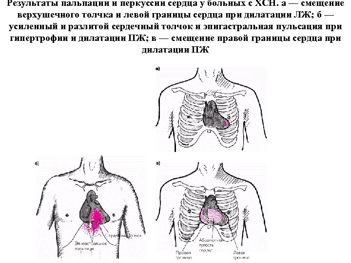 Результаты пальпации и перкуссии сердца у больных с ХСН. а — смещение верхушечного толчка