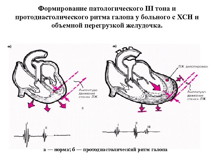 Формирование патологического III тона и протодиастолического ритма галопа у больного с ХСН и объемной