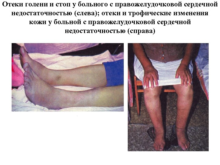 Отеки голени и стоп у больного с правожелудочковой сердечной недостаточностью (слева); отеки и трофические