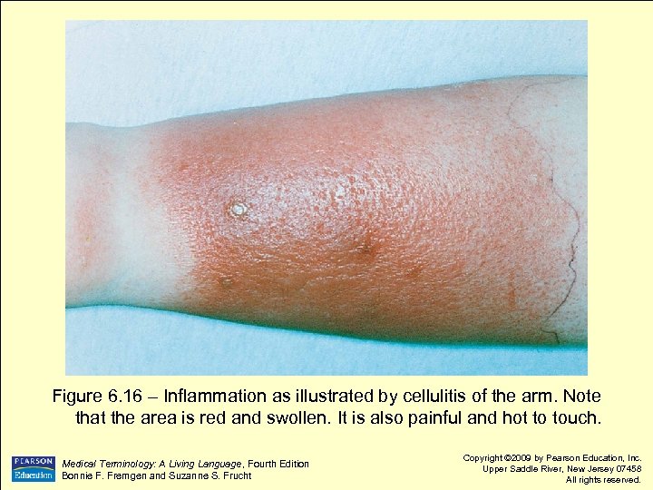 Figure 6. 16 – Inflammation as illustrated by cellulitis of the arm. Note that