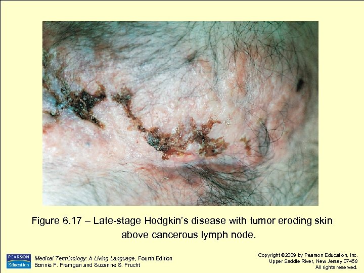 Figure 6. 17 – Late-stage Hodgkin’s disease with tumor eroding skin above cancerous lymph