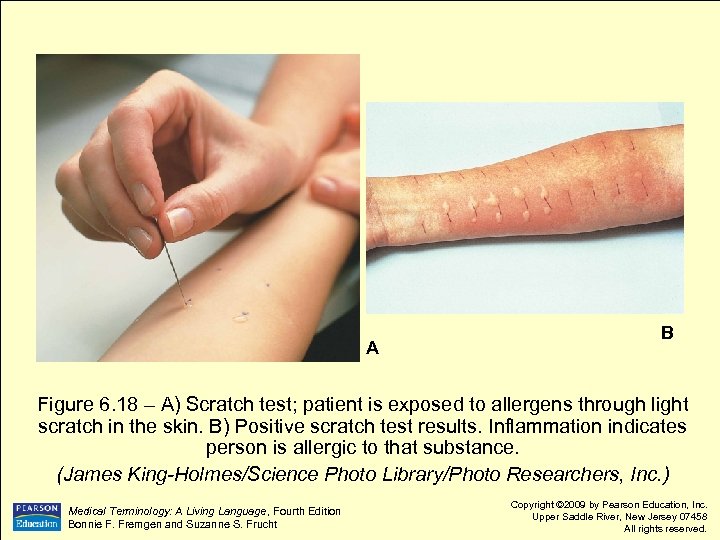 A B Figure 6. 18 – A) Scratch test; patient is exposed to allergens