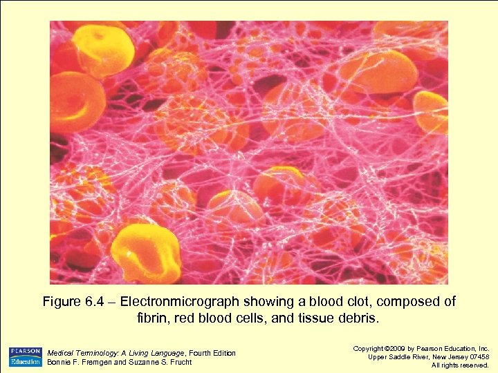 Figure 6. 4 – Electronmicrograph showing a blood clot, composed of fibrin, red blood