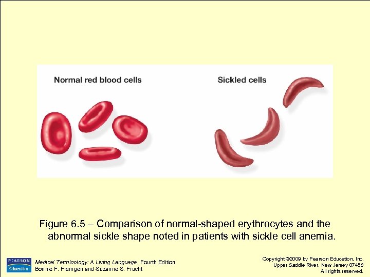 Figure 6. 5 – Comparison of normal-shaped erythrocytes and the abnormal sickle shape noted