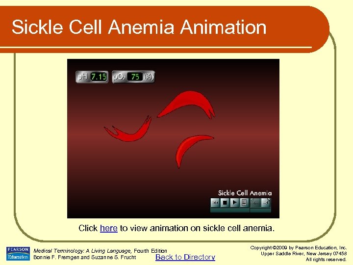 Sickle Cell Anemia Animation Click here to view animation on sickle cell anemia. Medical